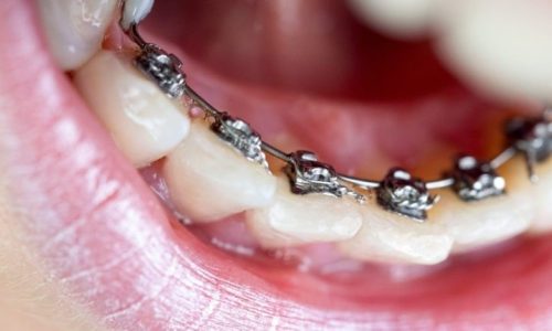 Lingual-braces-1